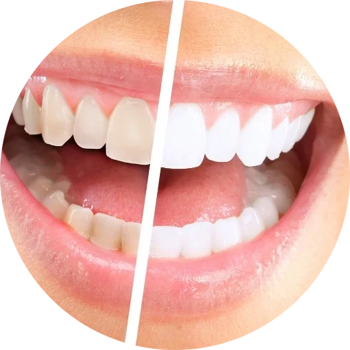 Баннер Отбелить зубы Баннер Отбелить зубы